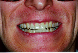 Type I teeth